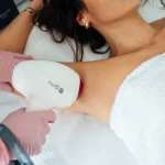 Epilare Definitiva
